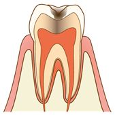 虫歯の状態の種類