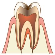 虫歯の状態の種類